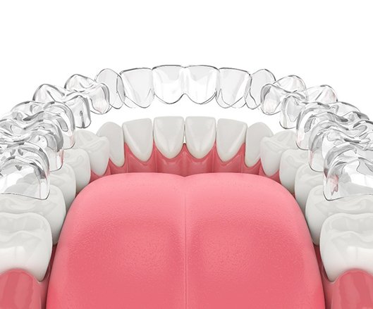 A digital image of a clear Invisalign aligner going on over the bottom arch of teeth