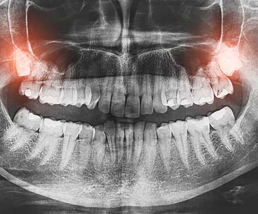 X-ray of smile with wisdom teeth highlighted