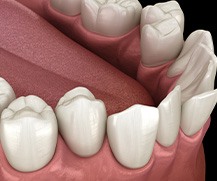 Illustration of crooked teeth