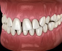 Illustration of gapped teeth