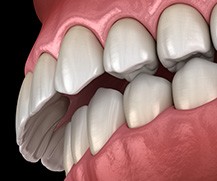 Illustration of an overbite