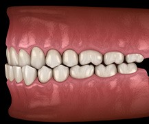 Illustration of an underbite