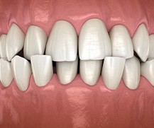 Illustration of a crossbite