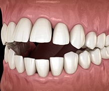 Illustration of an open bite