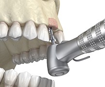 Bone grafting in Ellicott City