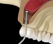 Sinus lift in Ellicott City