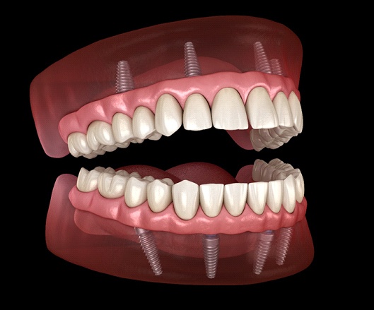 Digital model of All-On-4 dental implants.