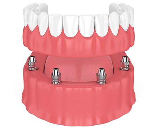 Image of lower denture using All-On-4.