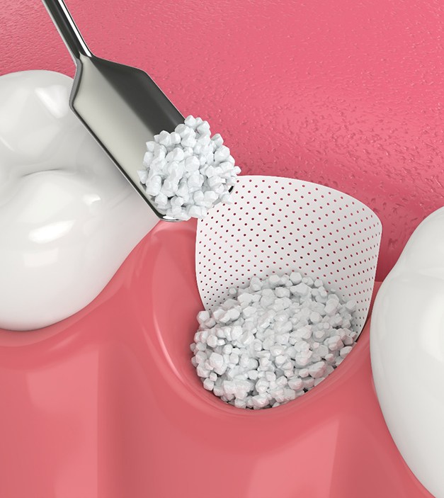  A CGI image of a bone grafting procedure