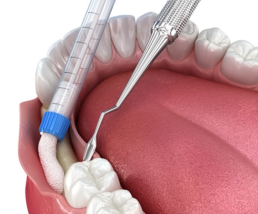 A CGI image of a bone graft