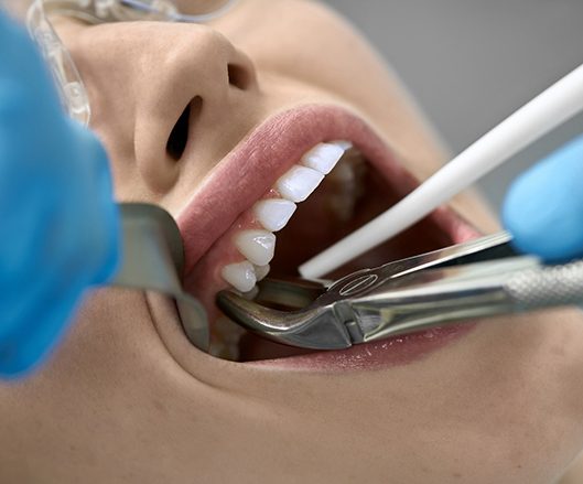 A woman having a tooth extracted