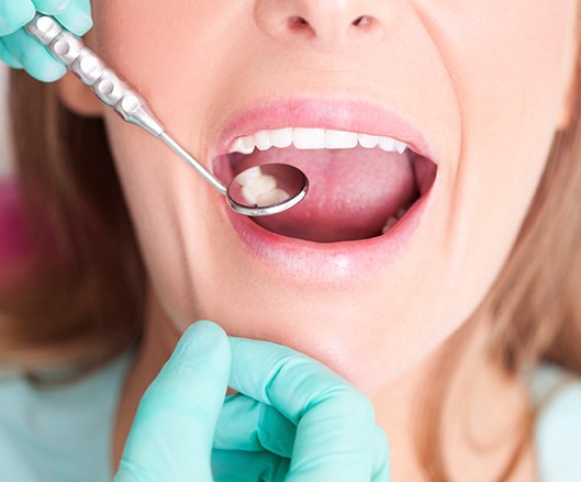 Dentist checking a smile after metal free dental restoration placement