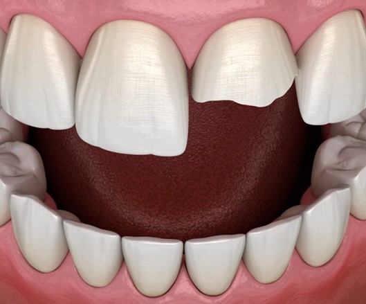 Dental model of a chipped front tooth.