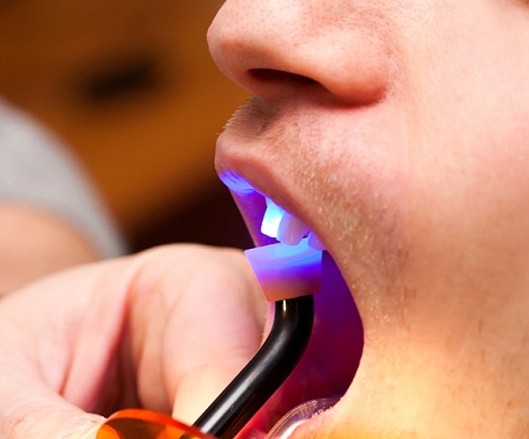 Man during dental bonding procedure.