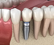 Animated dental implant retained dental crown