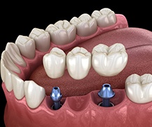 Animated dental implant supported fixed bridge placement