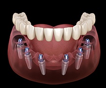 Animated dental implant supported denture