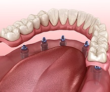 illustration of implant dentures in Ellicott City