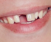 Smile with missing top tooth