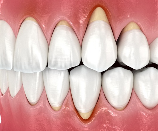 Illustration of receding gums
