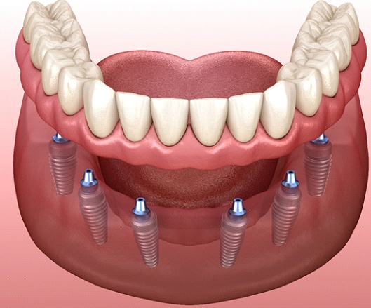 A digital image of an implant denture being placed over the top of six dental implants on the lower arch