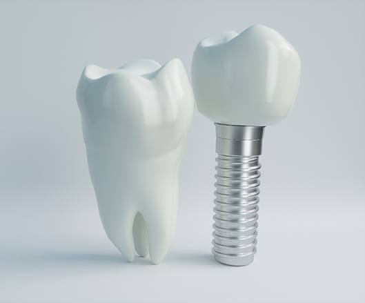 Diagram showing a natural tooth next to a dental implant