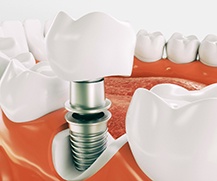 Diagram showing parts of dental implants in Ellicott City