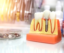 Model comparing dental implant and natural tooth