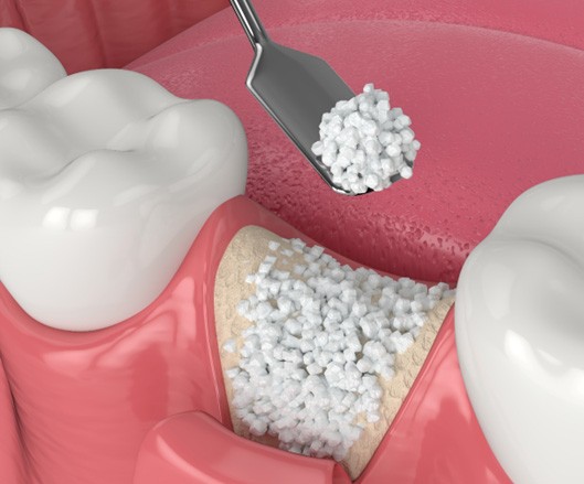 3D render of bone grafting