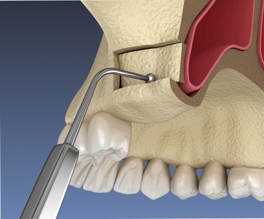 3D render of sinus lift