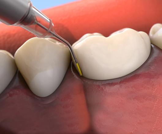 Animated arestin topical antibiotic treatment process