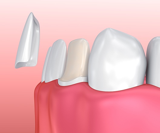 Animated porcelain veneer placement