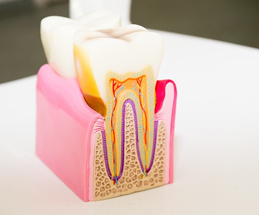 Model of the inside of a tooth before root canal therapy