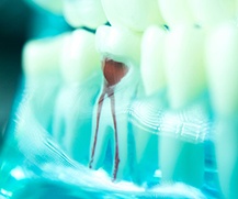 A closeup of a tooth that needs a root canal