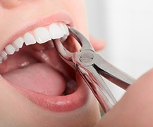 A dentist pulling a woman’s tooth