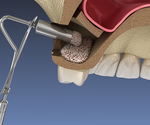a computer illustration showing bone grafting material being placed for a sinus lift procedure