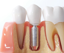 Osseointegration is where the dental implant permanently fuses with the jawbone