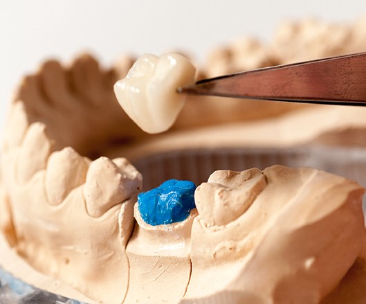 Model smile used during dental crown creation