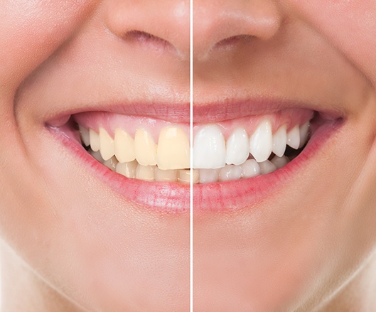 Patient's smile before and after teeth whitening
