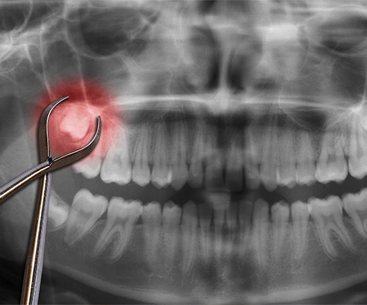 X-ray with wisdom tooth developing below gums