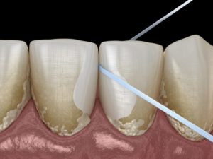 computer model of dental floss removing plaque between teeth