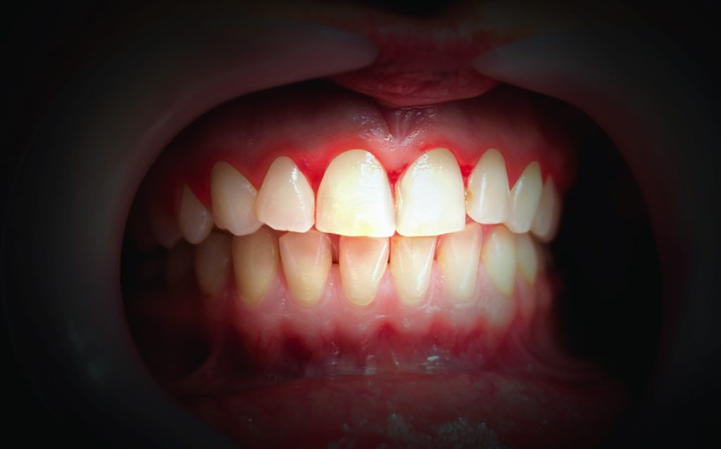 Bleeding gums