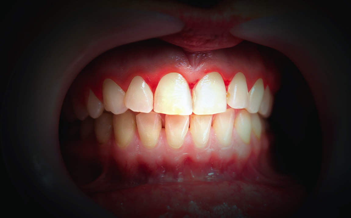 How to Prevent Bleeding Gums Ellicott City | Ellicott City Smiles