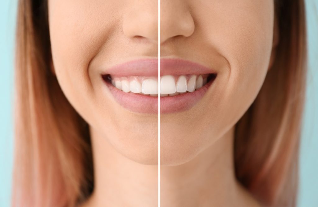 Closeup of woman's smile before and after gum recontouring
