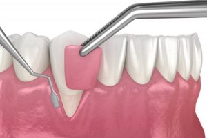model of gum grafting procedure
