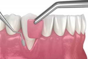 model of gum grafting procedure 