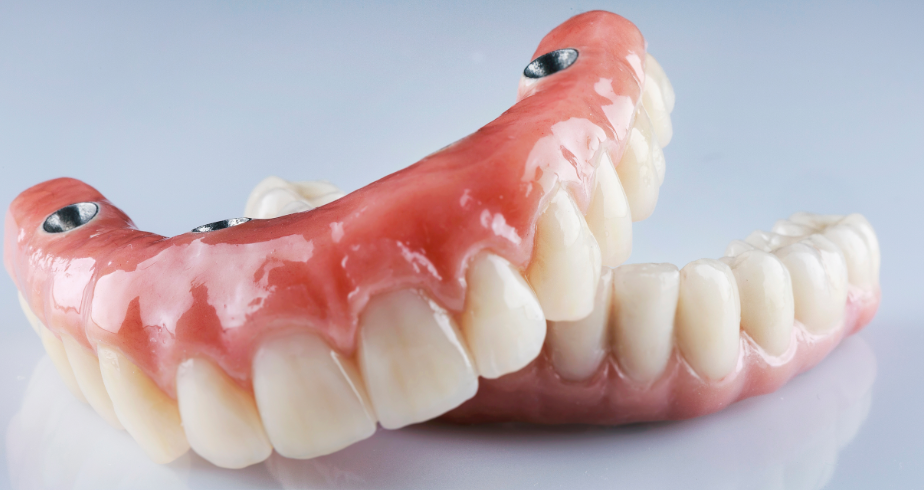Implant dentures