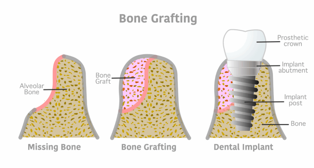 Illustrated cross section of a bone graft