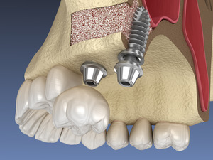 Illustration of dental implant in upper jaw after a sinus lift