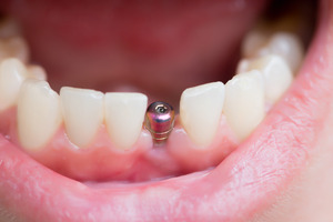 Close-up of single unrestored dental implant in the lower jaw